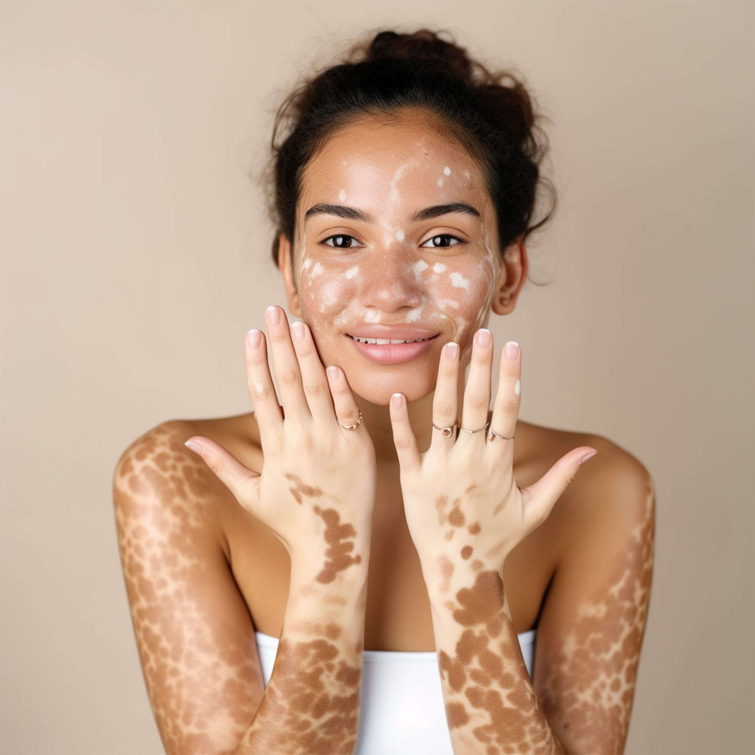 Vitiligo treatments